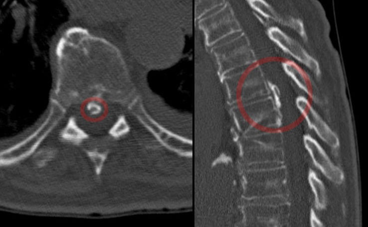 Axial and sagittal CT of thoracic ossification of the posterior longitudinal ligament.