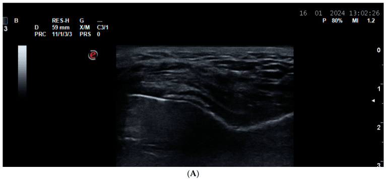 Ultrasound showing CPPD calcification within hyaline cartilage