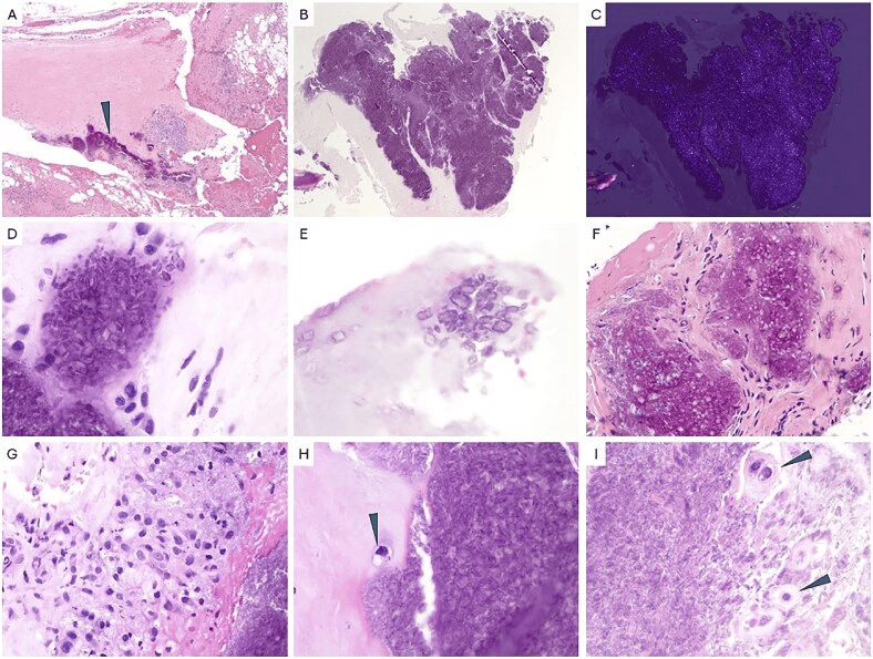 CPPD histology with birefringent basophilic deposits and rhomboid crystals