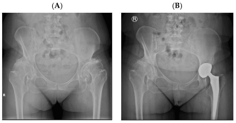 AP pelvis radiographs of left hip osteoarthritis secondary to developmental dysplasia before and after total hip arthroplasty