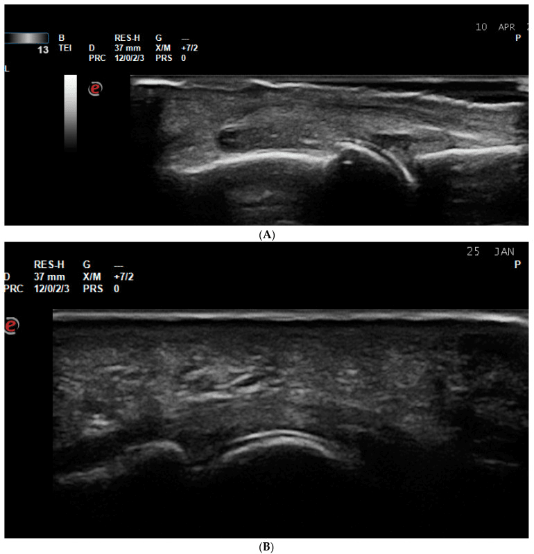 Ultrasound double-contour sign in gout