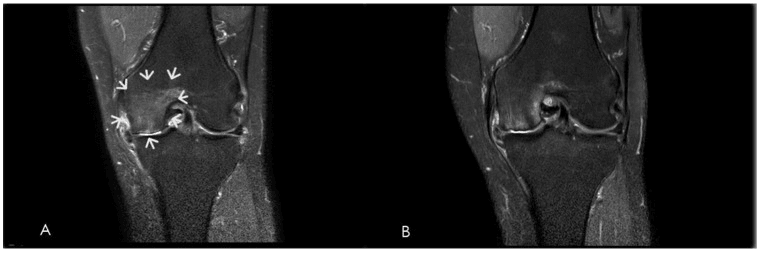Fat-suppressed knee MRI showing synovitis and medial bone marrow oedema, with a follow-up image showing less of both