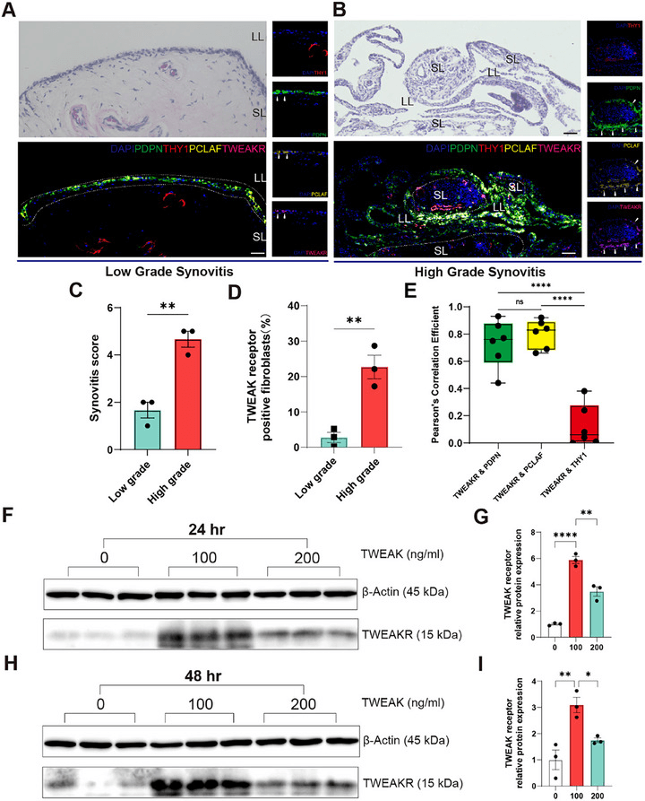 Low-grade and high-grade osteoarthritis synovitis in histology and multiplex immunostaining with quantification panels
