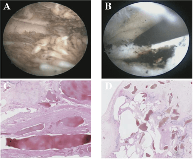 Arthroscopic and histological views of ochronotic pigmentation of cartilage and synovium