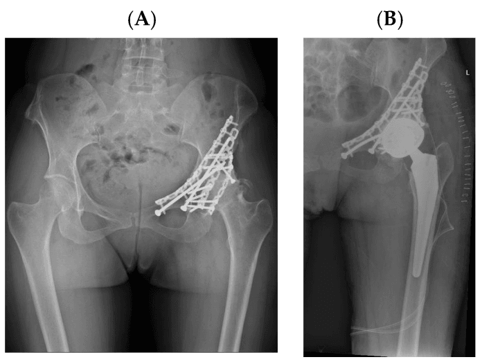 Post-traumatic left hip osteoarthritis after acetabular fracture fixation, before and after total hip arthroplasty