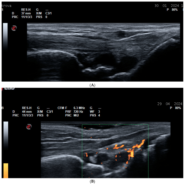 Grey-scale and power-Doppler ultrasound of rheumatoid synovitis