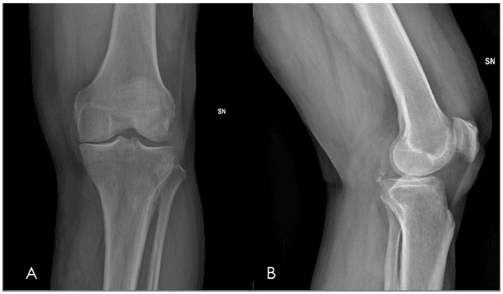 Radiographs showing joint-space loss sclerosis and marginal osteophytes in knee OA