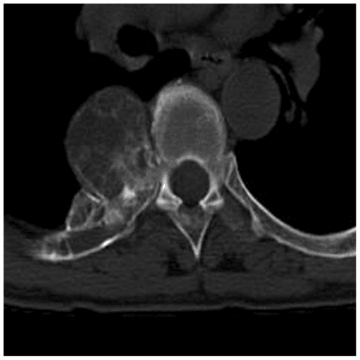 Axial CT of rib osteoblastoma