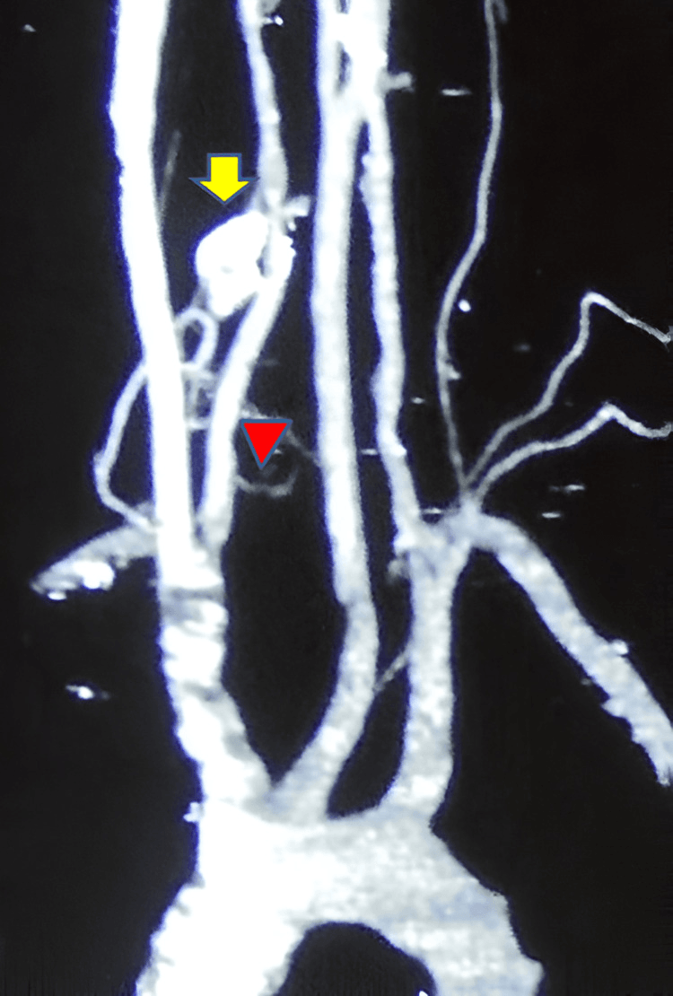 Three-dimensional CT angiography showing a cervical osteoblastoma (arrow) encroaching on the right vertebral artery (arrowhead)