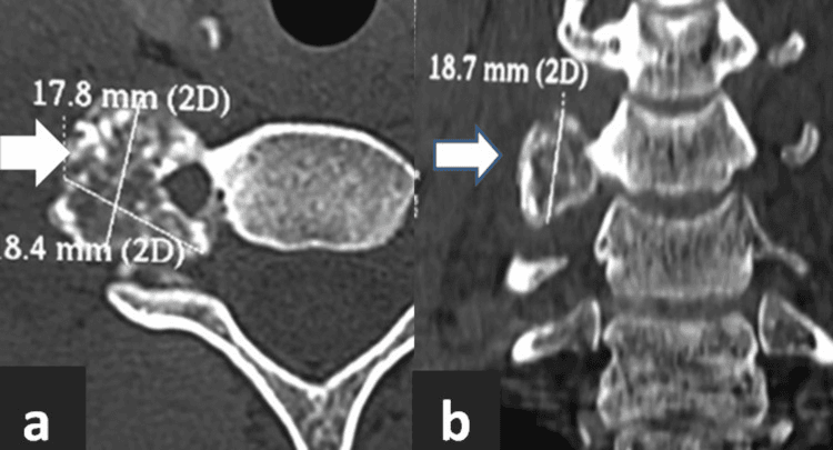 Axial (a) and coronal (b) CT showing a mixed lytic-sclerotic osteoblastoma arising from the right C6 transverse process