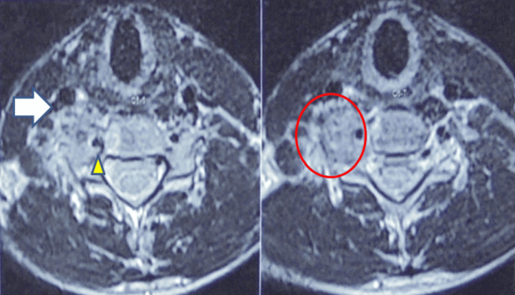 Axial cervical MRI showing a vascular mineralised osteoblastoma (arrow, circle) beside the carotid and vertebral arteries