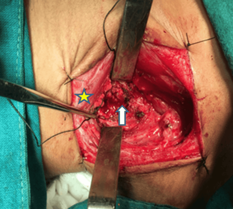 Intraoperative anterior cervical exposure with an arrow marking the osteoblastoma and a star marking the retracted sternocleidomastoid muscle