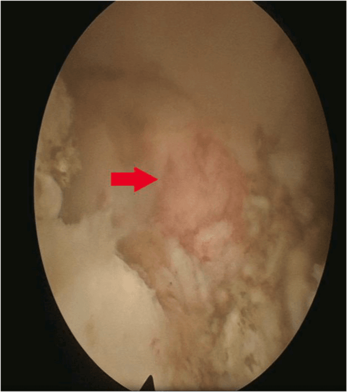 Endoscopic intraoperative view with a red arrow marking an osteoblastoma in the T4βT5 facet region