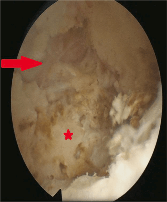Endoscopic view after thoracic osteoblastoma resection, a red arrow marking the lateral dural margin and a red star marking the dorsal T5 rib