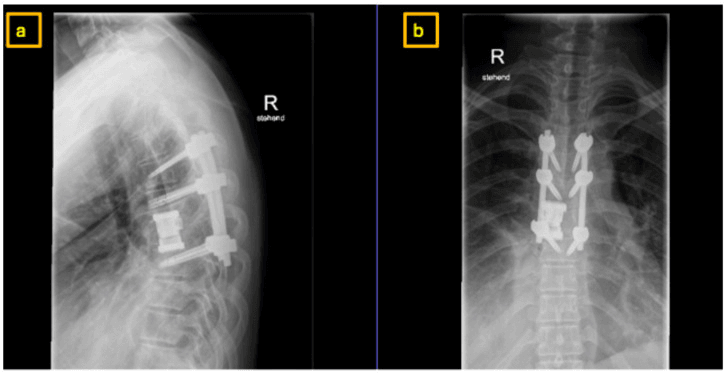 Lateral (a) and AP (b) thoracic radiographs after resection showing a vertebral-body cage and multilevel posterior pedicle-screw instrumentation