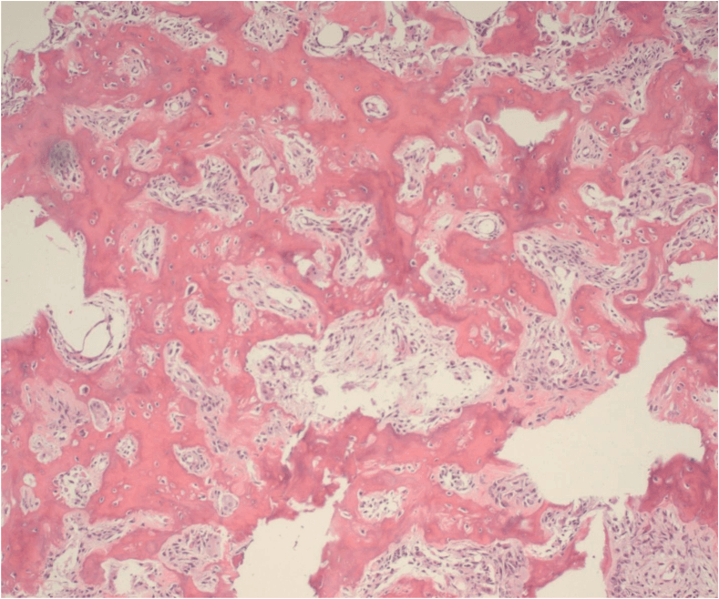 Haematoxylin and eosin micrograph showing interlacing woven-bone and osteoid trabeculae lined by prominent osteoblasts in a vascular stroma