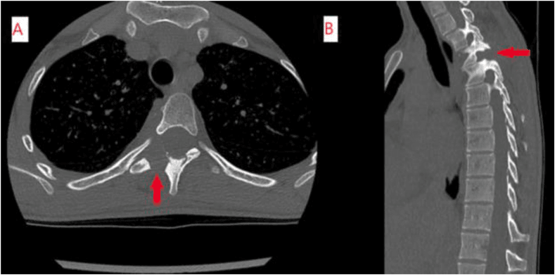Axial (A) and sagittal (B) postoperative CT, red arrows marking the thoracic facet region after complete resection of the osteoblastoma