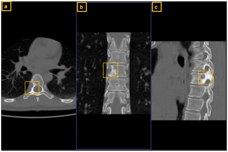 Axial (a), coronal (b) and sagittal (c) CT with boxes framing recurrent thoracic osteoblastoma extending from the pedicle root into the vertebral body