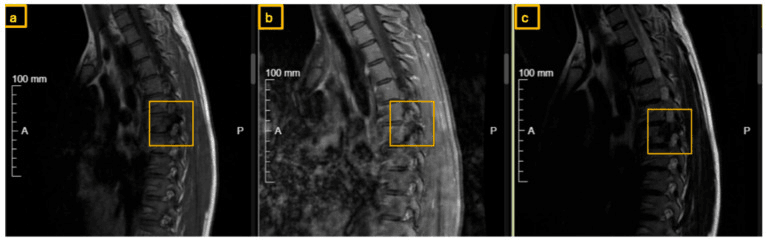 Three sagittal thoracic MRI panels (a to c), each with a 100 mm scale bar, with boxes framing recurrent osteoblastoma at the pedicle root