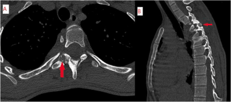 Axial (A) and sagittal (B) CT with red arrows marking a well-defined lytic osteoblastoma centred on the right T4βT5 facet joint
