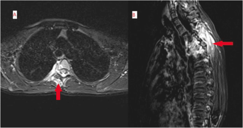 Axial (A) and sagittal (B) thoracic MRI of the facet-joint osteoblastoma, red arrows marking high signal in the surrounding paravertebral soft tissues