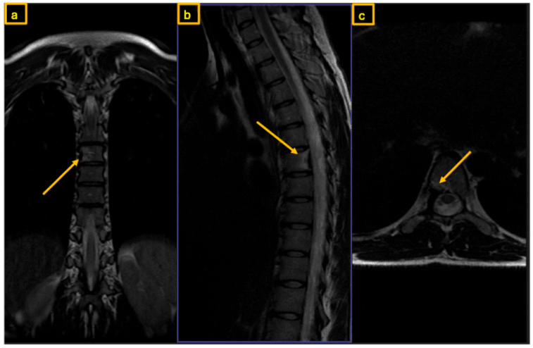 Coronal (a), sagittal (b) and axial (c) thoracic MRI with arrows marking an osteoblastoma at the root of the T7 pedicle