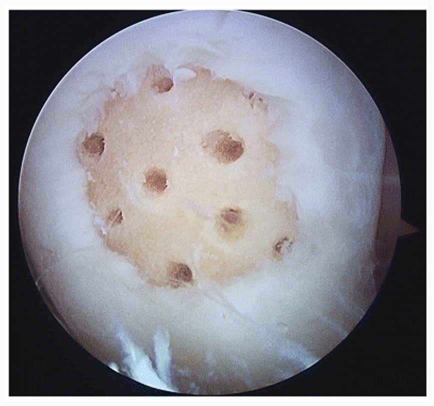 Arthroscopic view of a small, well-contained chondral lesion treated with microfracture, showing evenly spaced drill holes in the debrided lesion bed.