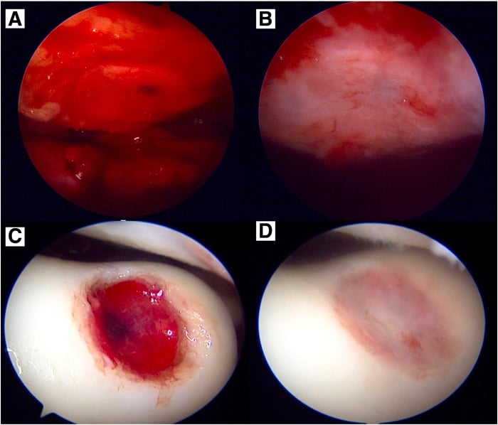 Arthroscopic sequence of two prepared cartilage defects (A, C) and the collagen scaffolds seated over them (B, D)