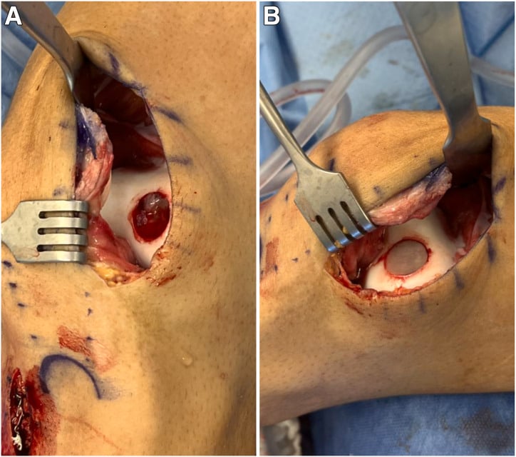 Open osteochondral defect after autologous bone grafting (A) and with a MACI scaffold in place (B)