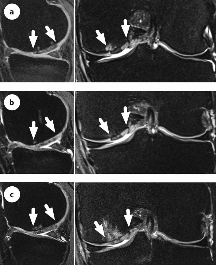 Serial sagittal and coronal proton-density MRI at two, five and ten years after AMIC of a femoral condyle defect, arrows marking the lesion
