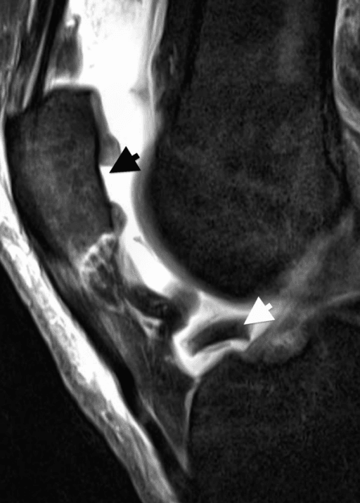 Sagittal PD-weighted TSE MRI of the knee showing a full-thickness patellar cartilage defect with the dislocated fragment lying free in the intercondylar notch.
