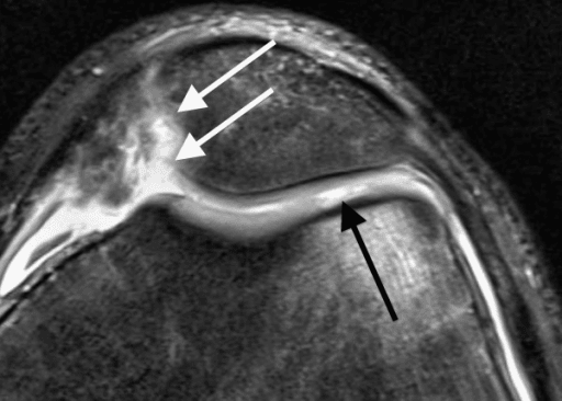 Axial PD-weighted TSE MRI of a 15-year-old with recurrent lateral patellar dislocation showing a full-thickness (ICRS grade 4) cartilage defect of the medial patellar facet with bony ulceration, plus a separate ICRS grade 3 lesion of the lateral femoral condyle.