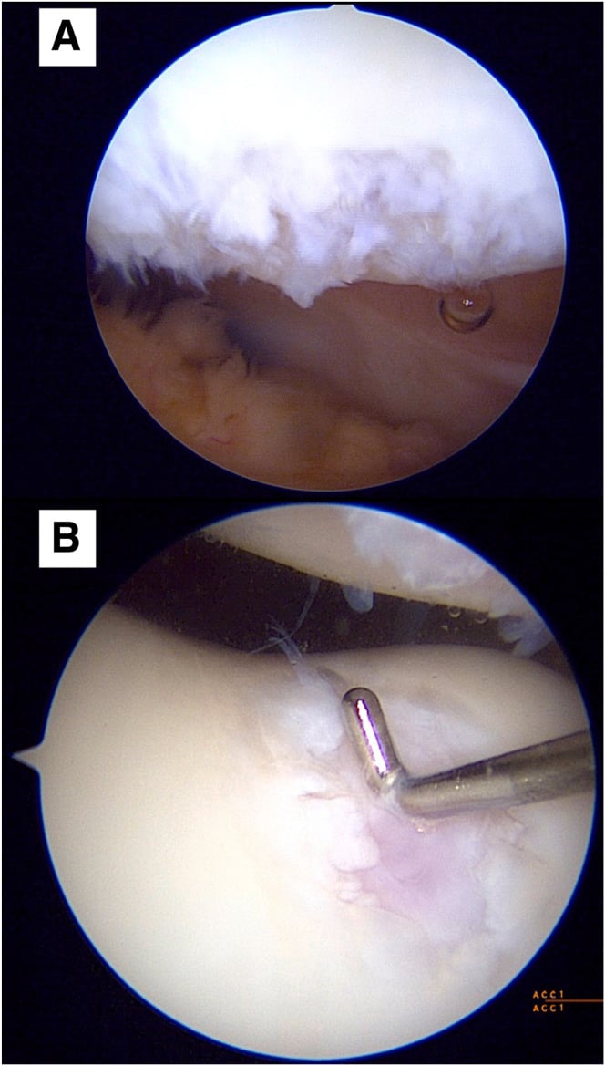 Arthroscopic views A and B of Outerbridge grade IV patellofemoral defects, with a probe on the lesion in panel B