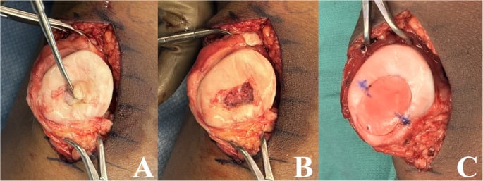 Open patellar osteochondral allograft reconstruction: the unsalvageable lesion (A), the recipient bed excised to healthy subchondral bone (B) and a flush size-matched donor plug (C)