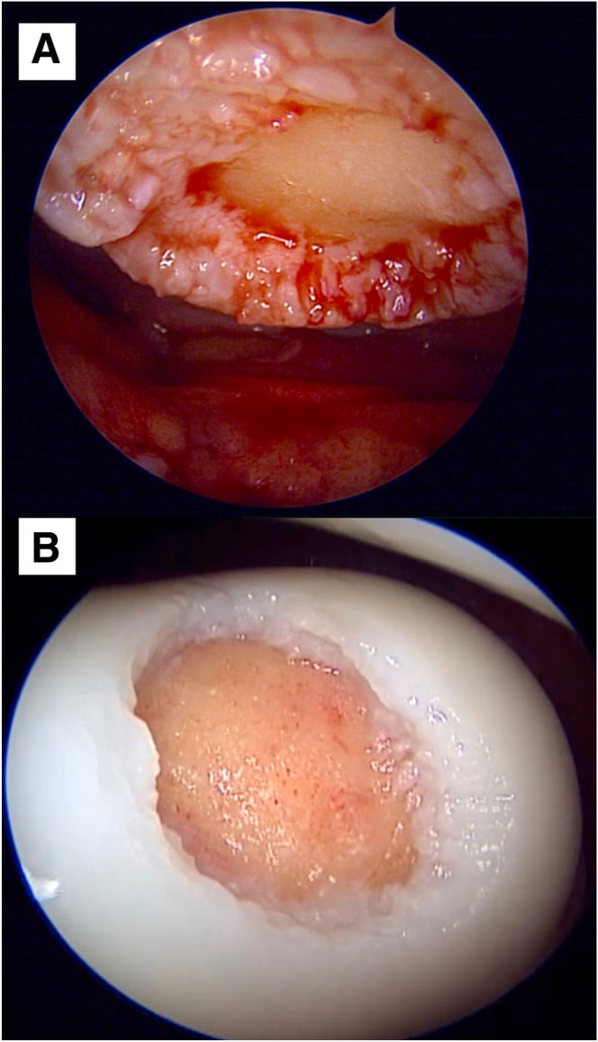 Arthroscopic views A and B of patellar and trochlear cartilage defects after debridement