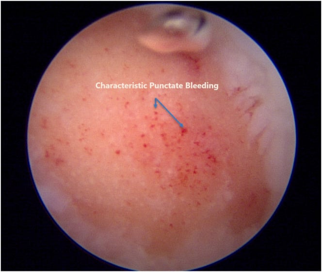 Arthroscopic view showing punctate bleeding across a prepared cartilage defect bed