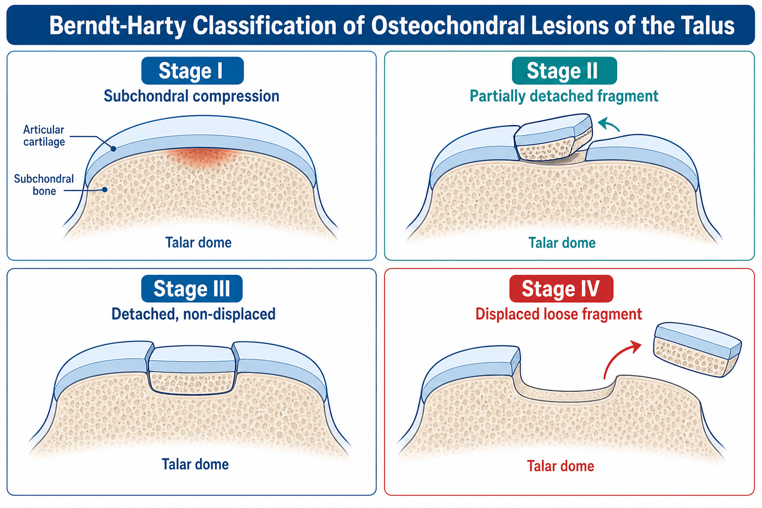 Berndt-Harty classification of talar osteochondral lesions