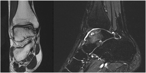 Coronal and sagittal MRI of an osteochondral lesion of the talar dome