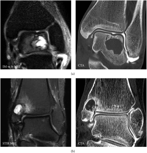 Composite MRI and CT arthrography of a medial talar dome osteochondral lesion