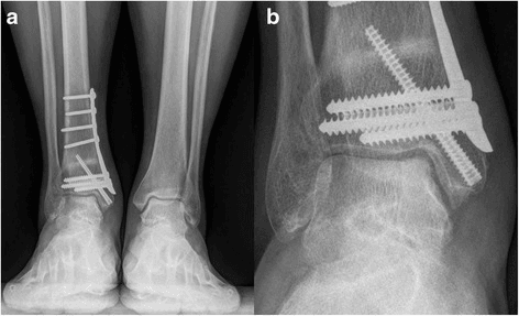 Postoperative ankle radiograph showing a corrective osteotomy with plate fixation after osteochondral grafting