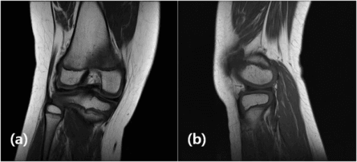 Our patient five months after operation. MRI study showing complete healing of the osteochondritis dissecans lesion of the lateral femoral condyle.