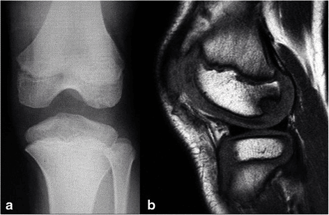 Weight-bearing Rosenberg-view radiograph and sagittal T1 MRI of a juvenile lateral femoral condyle osteochondritis dissecans lesion at 6 months of conservative treatment
