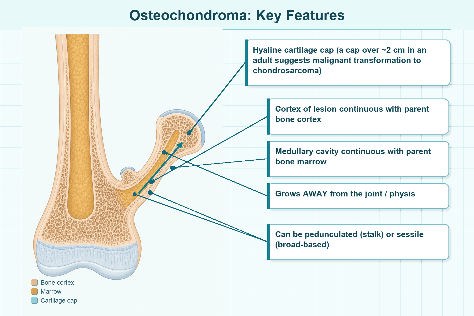 Cross-sectional diagram of an osteochondroma showing cortical and medullary continuity, the cartilage cap, growth away from the joint, and pedunculated versus sessile forms.