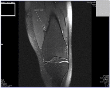 Sagittal knee MRI with an arrow on a distal femoral exostosis and an adjacent bursa.