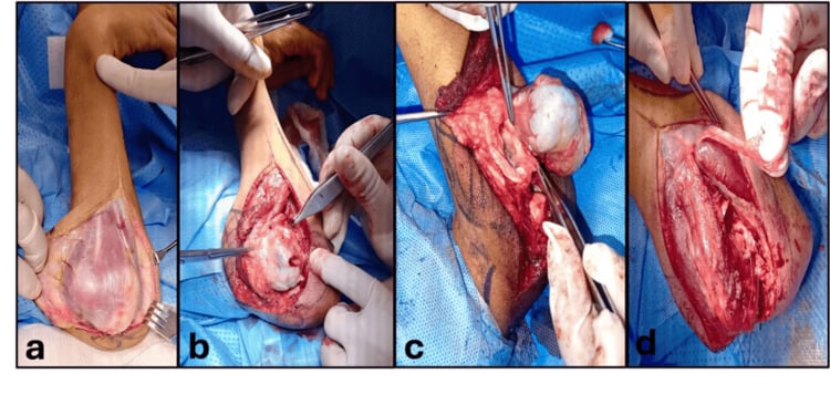 Four intraoperative panels showing exposure of a radial osteochondroma and identification of the posterior interosseous nerve