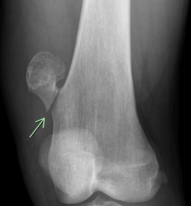 Oblique knee radiograph showing a fracture line through the stalk of a pedunculated distal-femoral osteochondroma