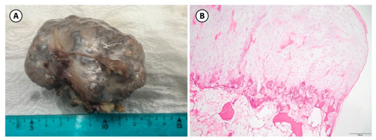 Gross sessile osteochondroma specimen and low-power histology showing cartilage cap over trabecular bone
