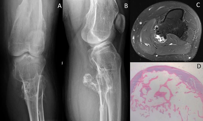 AP and lateral knee radiographs, axial T2 MRI and histology of osteochondromas in hereditary multiple exostoses