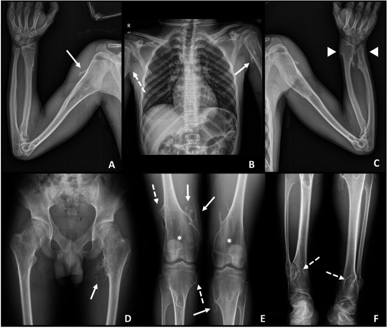 Six-panel skeletal survey showing widespread osteochondromas and limb deformity in hereditary multiple exostoses