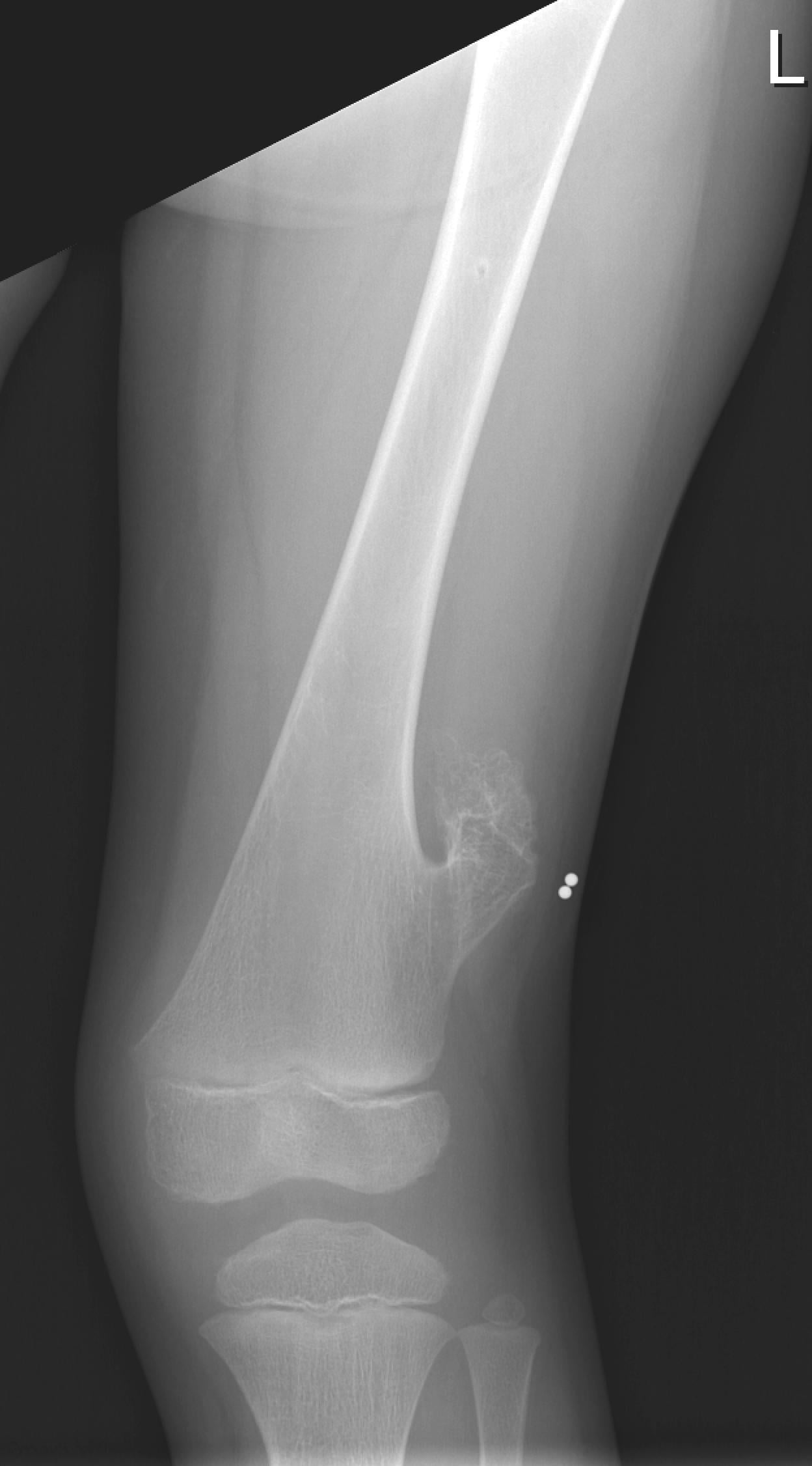 Frontal radiograph of a child's knee showing an osteochondroma arising from the medial distal femoral metaphysis.
